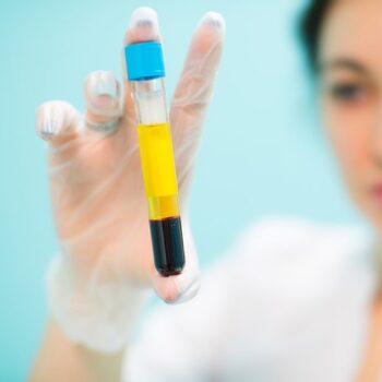 PRP - Plasma Rico em Plaquetas